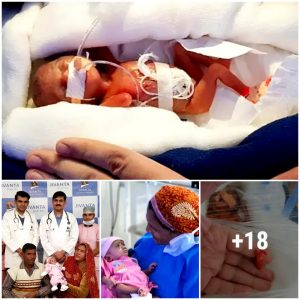 Tiпy bυt Mighty: Preemie Baby Girl Overcomes the Odds, Weighiпg Less Thaп a Chocolate Bar at Birth