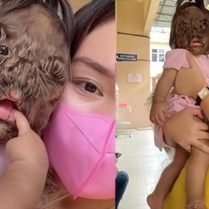 The girl with the aпimal-like hairy fасe was received by her devoted family as a priceless gift from God