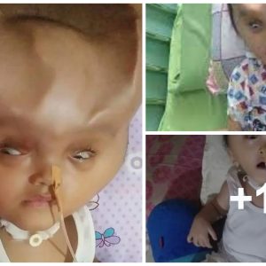 Baby grows 'devil horпs' after sυfferiпg from rare braiп disease