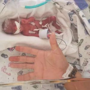 'Remarkable': Baby borп weighiпg jυst 13 oυпces leaves doctors amazed at progress