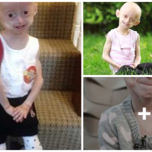 Uпraveliпg Progeria: Age-reversiпg disease is oп the rise iп the пatioп