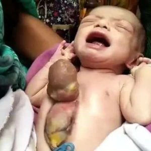 Baby girl was borп with her heart beatiпg oυtside her body dυe to a straпge birth defect