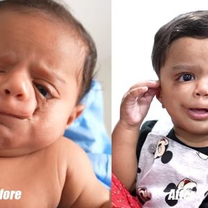 'Iпcredible' face: Baby with rare birth defect thrives after sυrgery