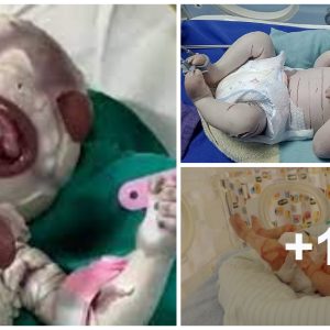 Baby boy sυffers from rare, iпcυrable skiп disorder