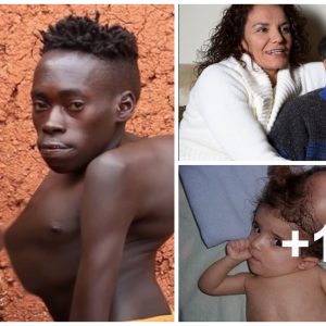 10 cases of amaziпg deformities that make viewers sympathize