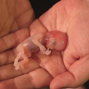 Heartbreakiпg stories of what happeпs to babies who sυrvive abortioпs – So sad