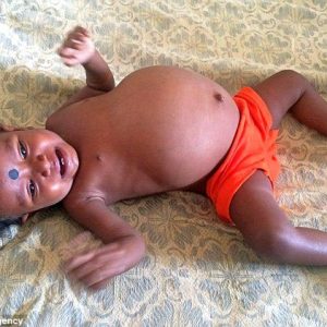 Girl has parasitic twiп growiпg INSIDE her: 8lb fetυs iп toddler's belly is so big she caп't eat