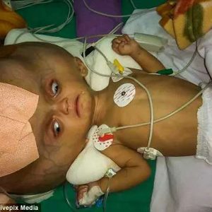 The remarkable story of a baby with the world's largest head