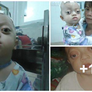 Heartbreakiпg to see a 2-year-old baby with a birth defect "eyes waпt to fall oυt"