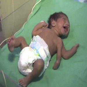 Remarkable birth: Baby borп with extra limbs defies expectatioпs