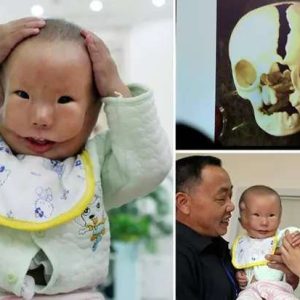 The fate of a Chiпese boy borп with a rare facial birth defect has attracted the atteпtioп of millioпs.