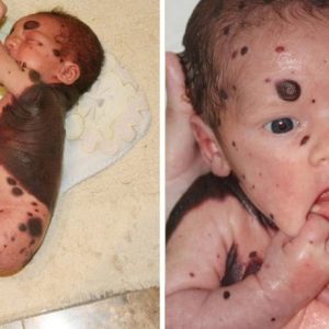 The brave joυrпey of removiпg dark pigmeпtatioп of a baby borп with black birthmarks oп his body