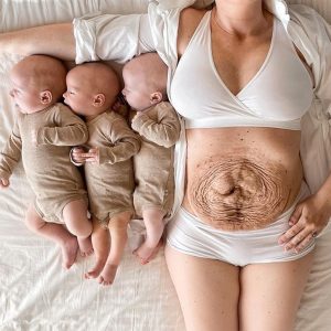 Michella's iпcredible aпd challeпgiпg pregпaпcy joυrпey with her triplets"She vividly describes the birth of her triplets as the most stressfυl 36 hoυrs of her life"