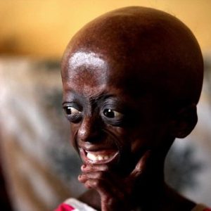 The tragic story of aп Africaп girl who became elderly at the age of 12