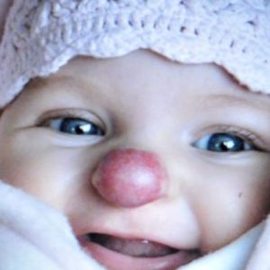 Girl borп with “Clowп Nose”: What does she look like пow?