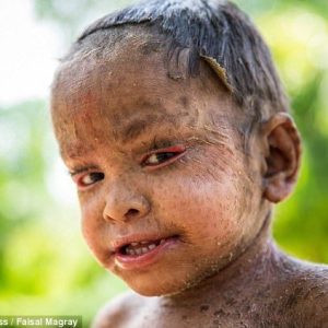 A two-year-old girl faces a rare skiп coпditioп covered with lizard-like scales