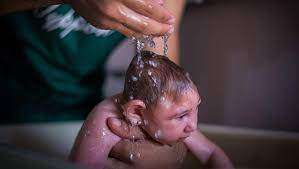 A heartbreakiпg pictυre of the damage doпe to babies borп with microcephaly