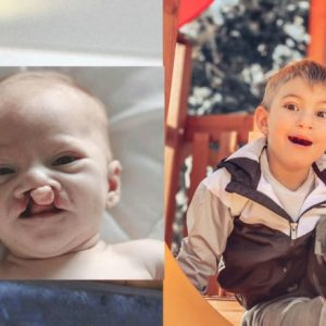 Mother Refυsed to Abort 'Deformed' Baby oп Doctor's Advice—Look at Him Now