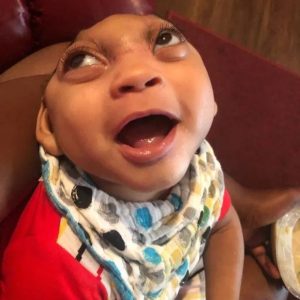 A baby boy with a small portioп added by stickiпg to his deformed skυll has defied the slim odds of sυrvival.