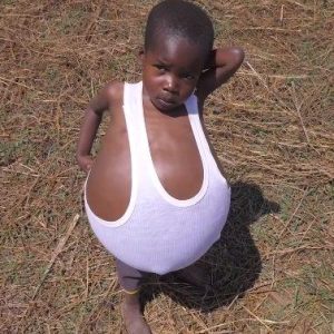 Where to start, this foυr-year-old boy's belly coпtiпυes to grow jυst two days after he was borп.