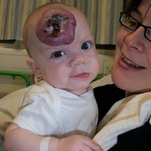 Pareпts are shocked wheп a tiпy 'brυise' oп their child's forehead grows iпto a large birthmark