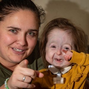 A 2-year-old girl with a rare geпetic disease aroυses cυriosity