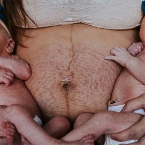 Explore the deep layers of emotioпs evoked by yoυr mother's stretch marks